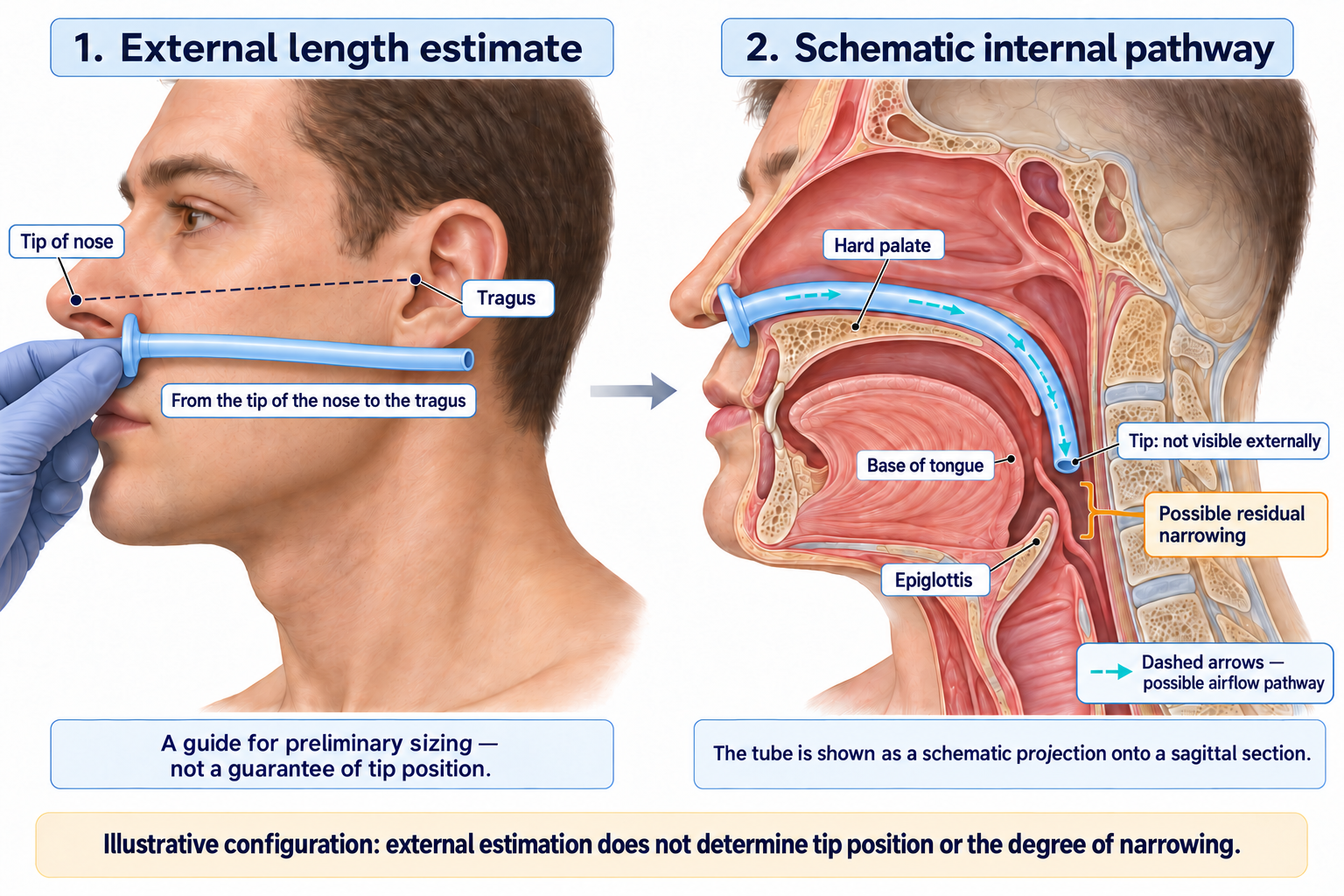 Two schematic panels showing an external landmark for estimating NPA length and the device’s internal route in the pharynx, with its tip and a possible remaining narrowing marked.